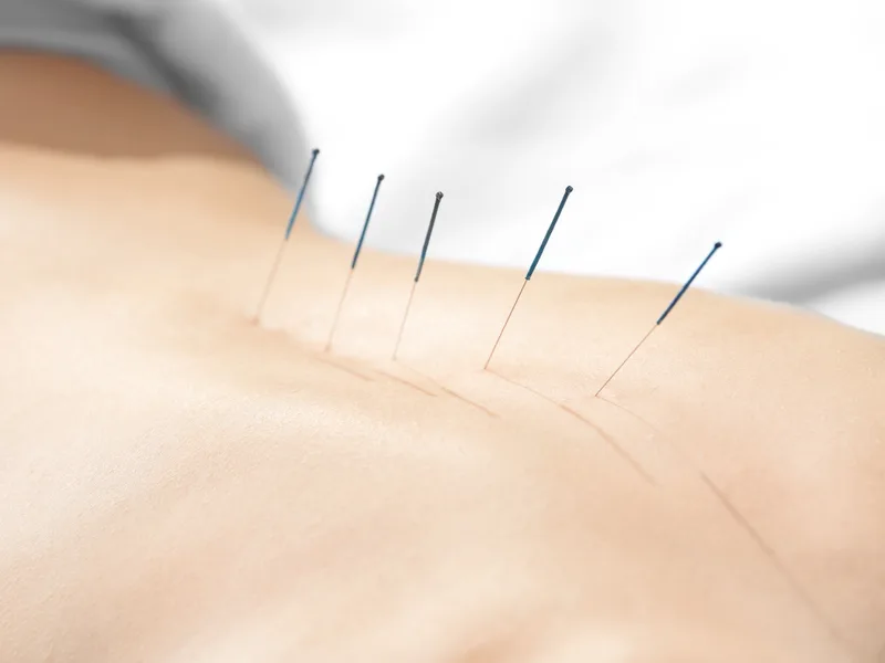 Acupuncture at Alma Sana Chiropractic Studio in Tucson