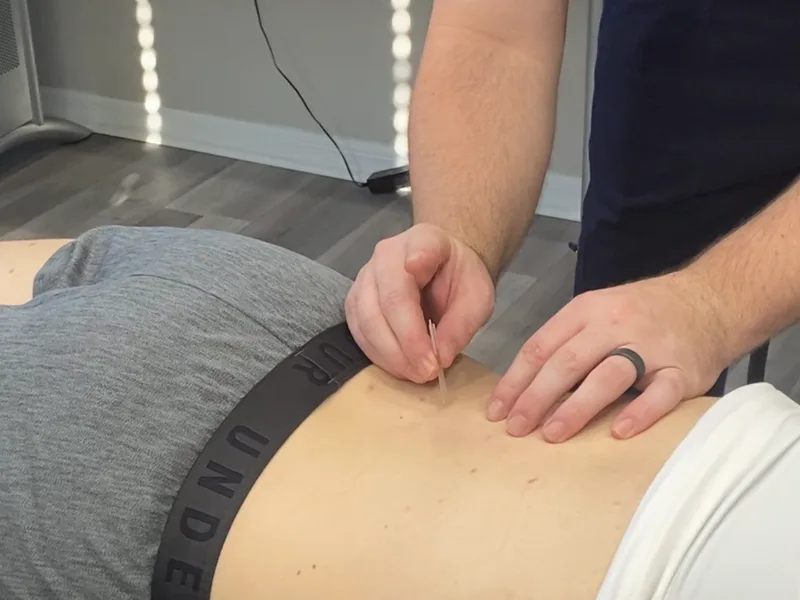 How Dry Needling works at Alma Sana Chiropractic Studio