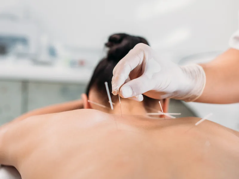 Dry Needling at Alma Sana Chiropractic Studio in Tucson